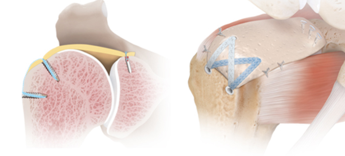 A New Solution for the Treatment of Massive and Irreparable Rotator Cuff  Tears: Superior Capsule Reconstruction - Michigan Orthopaedic Surgeons